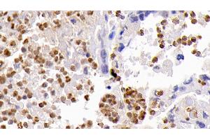 Detection of CASP3 in Human Lung cancer Tissue using Monoclonal Antibody to Caspase 3 (CASP3) (Caspase 3 Antikörper  (AA 29-175))