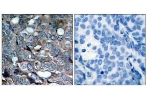 Immunohistochemical analysis of paraffin-embedded human breast carcinoma tissue using ASK1 (phospho-Ser83) antibody (E011178). (ASK1 Antikörper  (pSer83))