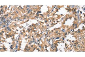 Immunohistochemistry of paraffin-embedded Human thyroid cancer tissue using HGF Polyclonal Antibody at dilution 1:65 (HGF Antikörper)