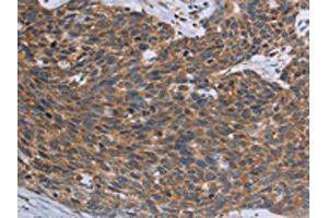 The image on the left is immunohistochemistry of paraffin-embedded Human cervical cancer tissue using ABIN7192846(TNPO1 Antibody) at dilution 1/25, on the right is treated with synthetic peptide. (Transportin 1 Antikörper)