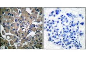 Immunohistochemistry analysis of paraffin-embedded human breast carcinoma, using PLCG1 (Phospho-Tyr783) Antibody. (Phospholipase C gamma 1 Antikörper  (pTyr783))