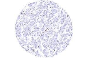 Ovarian clear cell carcinoma with complete lack of HMGB1 staining in tumor cells