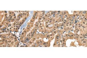 Immunohistochemistry of paraffin-embedded Human thyroid cancer tissue using RTCB Polyclonal Antibody at dilution of 1:30(x200) (C22orf28 Antikörper)