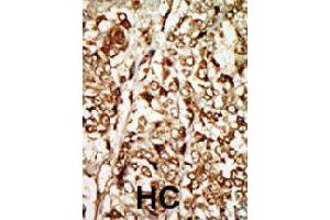 Formalin-fixed and paraffin-embedded human hepatocellular carcinoma tissue reacted with MOS polyclonal antibody  , which was peroxidase-conjugated to the secondary antibody, followed by AEC staining. (MOS Antikörper  (N-Term))