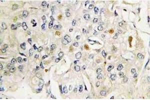 Immunohistochemistry (IHC) analyzes of VDR antibody in paraffin-embedded human breast carcinoma tissue. (Vitamin D Receptor Antikörper)