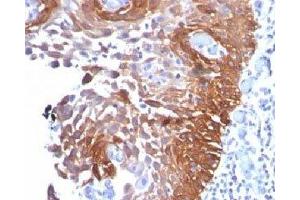 IHC testing of cervical carcinoma stained with Cytokeratin 17 antibody.