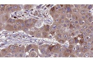 ABIN6276476 at 1/100 staining Human liver cancer tissue by IHC-P. (RHOC Antikörper  (C-Term))