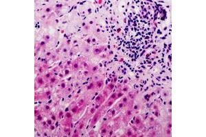 Immunohistochemical analysis of ARHGEF9 staining in human liver cancer formalin fixed paraffin embedded tissue section. (Arhgef9 Antikörper  (C-Term))