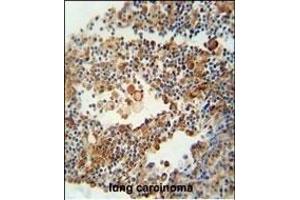OR9Q1 antibody (C-term) (ABIN654850 and ABIN2844515) immunohistochemistry analysis in formalin fixed and paraffin embedded human lung carcinoma followed by peroxidase conjugation of the secondary antibody and DAB staining.