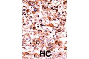 Formalin-fixed and paraffin-embedded human cancer tissue reacted with the primary antibody, which was peroxidase-conjugated to the secondary antibody, followed by AEC staining. (CDK1 Antikörper  (pSer39))