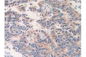 IHC-P analysis of Human Prostate Cancer Tissue, with DAB staining. (ETFB Antikörper  (AA 2-255))