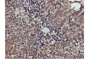 Immunohistochemical staining of paraffin-embedded Adenocarcinoma of Human breast tissue using anti-AKT1 mouse monoclonal antibody. (AKT1 Antikörper)