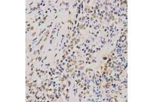 Immunohistochemistry of paraffin-embedded human lung cancer using TriMethyl-Histone H3-K79 antibody.
