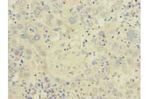 Immunohistochemistry of paraffin-embedded human liver cancer using ABIN7175581 at dilution of 1:100 (CACNA2D2 Antikörper  (AA 20-200))