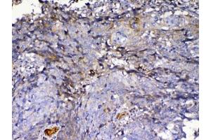 IHC testing of FFPE human lung cancer tissue with IGFBP2 antibody at 1ug/ml.