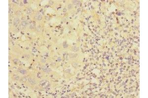 Immunohistochemistry of paraffin-embedded human liver cancer using ABIN7149008 at dilution of 1:100 (CSRP2 Antikörper  (AA 1-193))