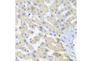 Immunohistochemistry of paraffin-embedded human liver injury using ABCB8 antibody. (ABCB8 Antikörper)
