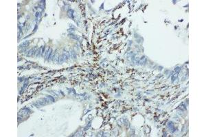 IHC-P: EIF6 antibody testing of human intestine cancer tissue (EIF6 Antikörper  (Middle Region))