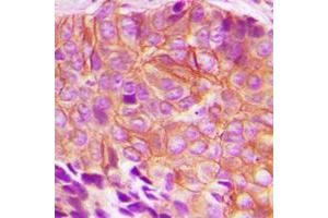 Immunohistochemical analysis of BIK (pT33) staining in human breast cancer formalin fixed paraffin embedded tissue section. (BIK Antikörper  (N-Term, pSer33))