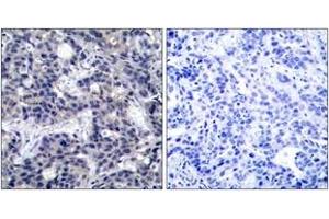 Immunohistochemistry analysis of paraffin-embedded human breast carcinoma tissue, using PKR (Ab-446) Antibody. (EIF2AK2 Antikörper  (AA 413-462))