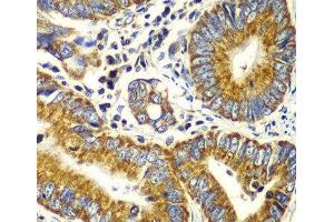 Immunohistochemistry of paraffin-embedded human colon carcinoma using TOMM20 antibody.