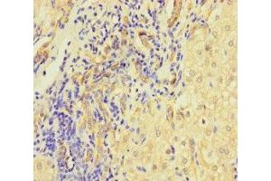 Immunohistochemistry of paraffin-embedded human liver cancer using ABIN7158401 at dilution of 1:100 (L1TD1 Antikörper  (AA 665-865))