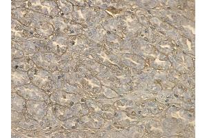 ABIN6264465 and ABIN6272654 at 1/100 staining human renal cell carcinoma by IHC-P. (PSG3 Antikörper  (C-Term))