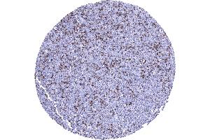Diffuse large B cell lymphoma containing a large number of CTLA 4 positive lymphocytes (Rekombinanter CTLA4 Antikörper)