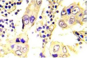 Immunohistochemistry (IHC) analyzes of SRC antibody in paraffin-embedded human breast carcinoma tissue. (NCOA1 Antikörper)