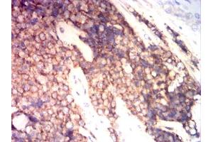 Immunohistochemical analysis of paraffin-embedded ewing sarcoma tissues using CD99 mouse mAb with DAB staining.