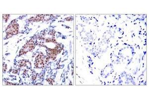 Immunohistochemical analysis of paraffin-embedded human breast carcinoma tissue using Elk-1(Phospho-Ser383) Antibody(left) or the same antibody preincubated with blocking peptide(right). (ELK1 Antikörper  (pSer383))