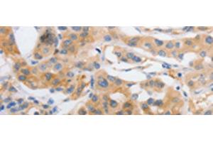 Immunohistochemistry of paraffin-embedded Human lung cancer tissue using MYOD1 Polyclonal Antibody at dilution of 1:120(x200)