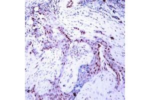 Immunohistochemical analysis of paraffin-embedded human breast carcinoma tissue using Progesterone Receptor(Phospho-Ser190) Antibody. (Progesterone Receptor Antikörper  (pSer190))