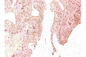 Formalin-fixed, paraffin-embedded human Small Cell Lung Carcinoma stained with Chromogranin A Monoclonal Antibody (LK2H10) (Chromogranin A Antikörper)