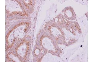 IHC-P Image GBF1 antibody [N1], N-term detects GBF1 protein at cytoplasm on human colon carcinoma by immunohistochemical analysis. (GBF1 Antikörper  (N-Term))