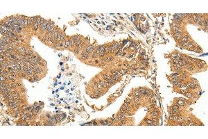 Immunohistochemistry of paraffin-embedded Human colon cancer using SLC32A1 Polyclonal Antibody at dilution of 1:35 (SLC32A1 Antikörper)