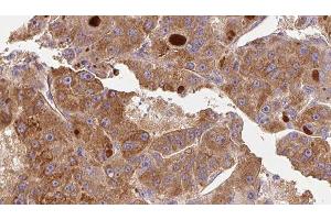 ABIN6276739 at 1/100 staining Human liver cancer tissue by IHC-P. (CD11b Antikörper  (Internal Region))