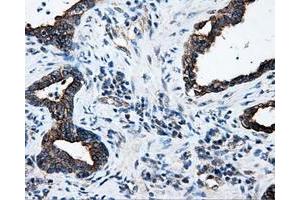 Immunohistochemical staining of paraffin-embedded Adenocarcinoma of colon tissue using anti-SRRmouse monoclonal antibody. (SRR Antikörper)