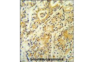 Formalin-fixed and paraffin-embedded human prostate carcinoma reacted with MGST2 Antibody ,which was peroxidase-conjugated to the secondary antibody, followed by DAB staining. (MGST2 Antikörper  (C-Term))