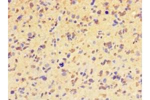 Immunohistochemistry of paraffin-embedded human glioma using ABIN7155399 at dilution of 1:100 (HIST1H2BD Antikörper  (AA 2-57))