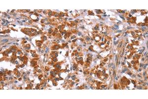 Immunohistochemistry of paraffin-embedded Human thyroid cancer tissue using GLMN Polyclonal Antibody at dilution 1:40 (GLMN Antikörper)