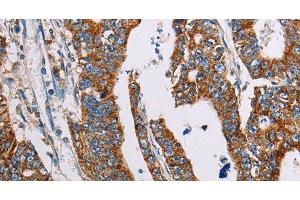 Immunohistochemistry of paraffin-embedded Human gasrtic cancer tissue using ALG2 Polyclonal Antibody at dilution 1:35 (ALG2 Antikörper)