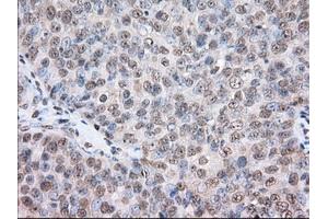 Immunohistochemical staining of paraffin-embedded Human colon tissue using anti-TACC3 mouse monoclonal antibody. (TACC3 Antikörper)
