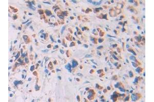 IHC-P analysis of Human Stomach cancer Tissue, with DAB staining. (Ribonuclease A12 (AA 21-147) Antikörper)