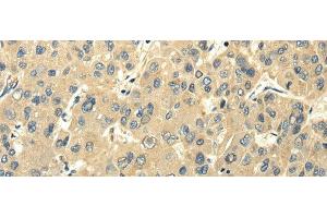 Immunohistochemistry of paraffin-embedded Human liver cancer using PMP2 Polyclonal Antibody at dilution of 1/25 (PMP2 Antikörper)