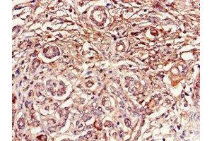 Immunohistochemistry of paraffin-embedded human pancreatic cancer using ABIN7150756 at dilution of 1:100 (DUSP19 Antikörper  (AA 1-217))