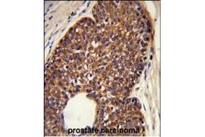 Formalin-fixed and paraffin-embedded human prostate carcinoma reacted with MTBP Antibody (C-term), which was peroxidase-conjugated to the secondary antibody, followed by DAB staining. (MTBP Antikörper  (C-Term))