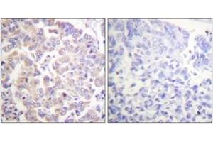 Immunohistochemistry analysis of paraffin-embedded human breast carcinoma, using APC1 (Phospho-Ser688) Antibody. (APC1 Antikörper  (pSer688))