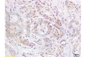 Formalin-fixed and paraffin embedded human cervical carcinoma labeled with Anti-PXMP1/ABCD3/PMP70 Polyclonal Antibody, Unconjugated (ABIN1386868) at 1:200 followed by conjugation to the secondary antibody and DAB staining. (PMP70 Antikörper  (AA 51-160))