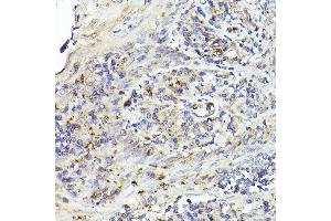 Immunohistochemistry of paraffin-embedded human tonsil using IL6R Rabbit pAb (ABIN3015521, ABIN3015522, ABIN3015523, ABIN1680455 and ABIN6218635) at dilution of 1:50 (40x lens). (IL-6 Receptor Antikörper  (AA 20-320))